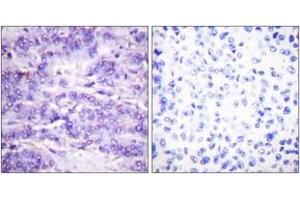 Immunohistochemistry analysis of paraffin-embedded human breast carcinoma, using MDM2 (Phospho-Ser166) Antibody. (MDM2 抗体  (pSer166))