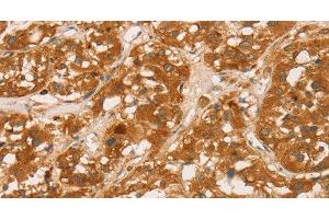 Immunohistochemistry of paraffin-embedded Human thyroid cancer tissue using CD43 Polyclonal Antibody at dilution 1:60 (CD43 抗体)