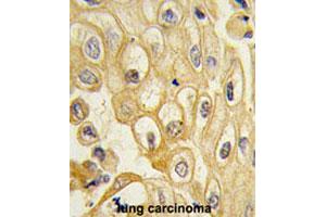 Formalin-fixed and paraffin-embedded human lung carcinomareacted with ROR1 polyclonal antibody , which was peroxidase-conjugated to the secondary antibody, followed by AEC staining. (ROR1 抗体  (AA 112-399))