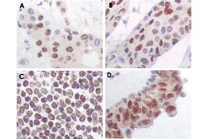 Immunohistochemical analysis of paraffin-embedded human liver carcinoma (A), esophagus carcinoma (B), normal spleen tissue(C), breast carcinoma (D), showing nuclear and cytoplasmic localization using MAPKAPK5 monoclonal antibody, clone 7H10B4  with DAB staining.