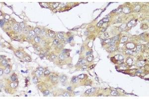 Immunohistochemistry of paraffin-embedded Human liver cancer using FKBP10 Polyclonal Antibody at dilution of 1:150 (40x lens). (FKBP10 抗体)