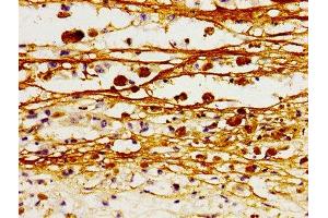Immunohistochemistry of paraffin-embedded human melanoma using ABIN7161199 at dilution of 1:100 (L1CAM 抗体  (AA 995-1119))