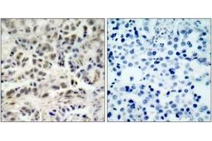 Immunohistochemistry analysis of paraffin-embedded human lung carcinoma tissue, using p27 Kip1 (Ab-10) Antibody. (CDKN1B 抗体  (AA 1-50))