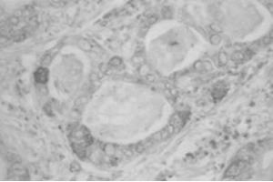 IHC on human uterine cervical adenocarcinoma (RCAS1 抗体)
