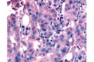 Anti-NANP antibody IHC of human Breast, Carcinoma. (NANP 抗体  (Internal Region))