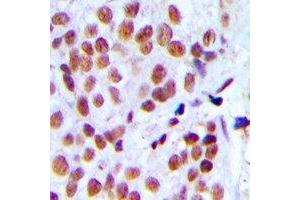Immunohistochemical analysis of hnRNP L staining in human breast cancer formalin fixed paraffin embedded tissue section. (HNRNPL 抗体)