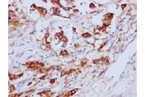 IHC image of ABIN7180656 diluted at 1:100 and staining in paraffin-embedded human gastric cancer performed on a Leica BondTM system. (CEACAM5 抗体)
