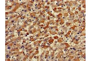 Immunohistochemistry of paraffin-embedded human liver cancer using ABIN7173471 at dilution of 1:100 (TRIM59 抗体  (AA 126-181))