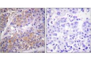 Immunohistochemistry analysis of paraffin-embedded human breast carcinoma, using p70 S6 Kinase (Phospho-Ser371) Antibody. (RPS6KB1 抗体  (pSer371))