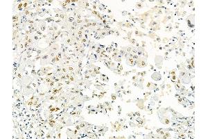 ABIN6266359 and ABIN6276704 at 1/100 staining Human lung cancer by IHC-P. (PRMT5 抗体  (Internal Region))