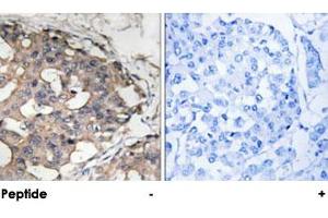 Immunohistochemical analysis of paraffin-embedded human breast carcinoma tissue using BRAF polyclonal antibody . (BRAF 抗体)