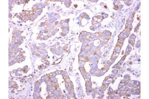 IHC-P Image Bif-1 antibody detects Bif-1 protein at cytosol on human ovarian carcinoma by immunohistochemical analysis. (ZBTB24 抗体  (C-Term))