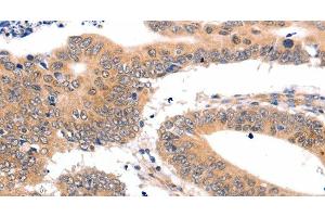 Immunohistochemistry of paraffin-embedded Human colon cancer tissue using SEMA3G Polyclonal Antibody at dilution 1:30