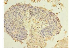 Immunohistochemistry of paraffin-embedded human cervical cancer using ABIN7173459 at dilution of 1:100 (TRIM51 抗体  (AA 160-452))