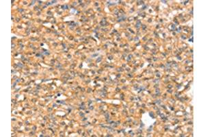 The image on the left is immunohistochemistry of paraffin-embedded Human prostate cancer tissue using ABIN7192491(SLC43A2 Antibody) at dilution 1/20, on the right is treated with synthetic peptide. (SLC43A2 抗体)