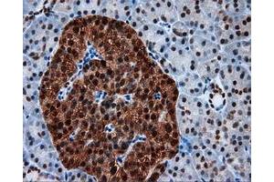 Immunohistochemical staining of paraffin-embedded Adenocarcinoma of colon tissue using anti-SIL1 mouse monoclonal antibody. (SIL1 抗体)