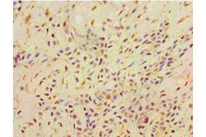 Immunohistochemistry of paraffin-embedded human breast cancer using ABIN7168521 at dilution of 1:100 (AHCYL1 抗体  (AA 31-260))