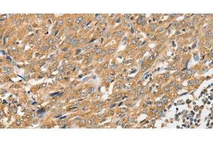 Immunohistochemistry of paraffin-embedded Human esophagus cancer tissue using ANGPTL7 Polyclonal Antibody at dilution 1:40 (ANGPTL7 抗体)