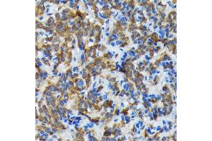 Immunohistochemistry of paraffin-embedded human thyroid cancer using Thyroid Peroxidase Rabbit mAb (ABIN7270865) at dilution of 1:100 (40x lens). (TPO 抗体)