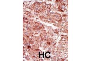 Formalin-fixed and paraffin-embedded human cancer tissue reacted with the primary antibody, which was peroxidase-conjugated to the secondary antibody, followed by AEC staining. (HK3 抗体  (C-Term))