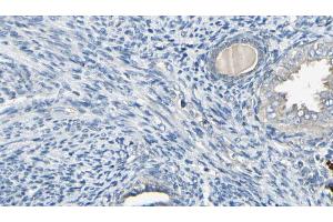 ABIN6272591 at 1/100 staining Human cervical cancer tissue by IHC-P. (IFI6 抗体)