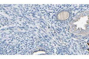 ABIN6272591 at 1/100 staining Human cervical cancer tissue by IHC-P.