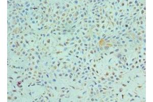 Immunohistochemistry of paraffin-embedded human breast cancer using ABIN7172544 at dilution of 1:100 (ETV6 抗体  (AA 1-300))