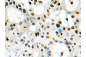 Immunohistochemistry analyzes of hnRNP A1 antibody in paraffin-embedded human liver carcinoma tissue. (HNRNPA1 抗体)