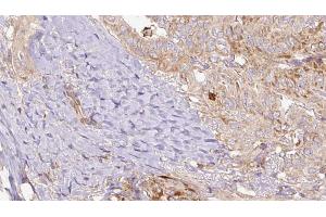 ABIN6267169 at 1/100 staining Human thyroid cancer tissue by IHC-P. (REPS1 抗体  (pSer709))