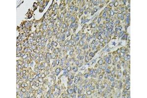 Immunohistochemistry of paraffin-embedded Human liver cancer using RASSF1 Polyclonal Antibody at dilution of 1:100 (40x lens). (RASSF1 抗体)