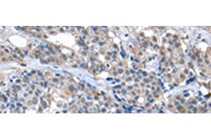 Immunohistochemistry of paraffin-embedded Human breast cancer tissue using ZFP2 Polyclonal Antibody at dilution of 1:40(x200) (ZFP2 抗体)