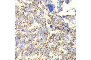 Immunohistochemistry of paraffin-embedded human esophageal cancer using GLUD2 antibody at dilution of 1:100 (x40 lens). (GLUD2 抗体)