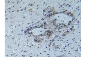 IHC-P analysis of Human Pancreas Cancer Tissue, with DAB staining. (RFTN1 抗体  (AA 288-520))