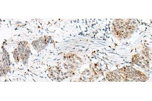 Immunohistochemistry of paraffin-embedded Human esophagus cancer tissue using PLCL2 Polyclonal Antibody at dilution of 1:50(x200) (PLCL2 抗体)