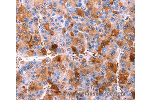 Immunohistochemistry of Human thyroid cancer using ERN2 Polyclonal Antibody at dilution of 1:40 (ERN2 抗体)
