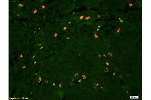 Formalin-fixed and paraffin embedded human glioma tissue labeled with Anti Lyn Polyclonal Antibody, PE conjugated (ABIN681493) at 1:200 dilution for 60 minutes at 37°C. (LYN 抗体  (AA 201-300))
