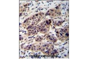 WDR42C Antibody (N-term) (ABIN655843 and ABIN2845256) immunohistochemistry analysis in formalin fixed and paraffin embedded human breast carcinoma followed by peroxidase conjugation of the secondary antibody and DAB staining. (DCAF8L2 抗体  (N-Term))