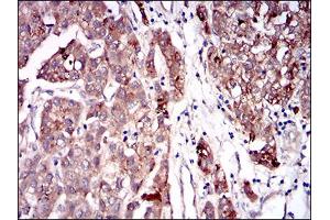 Immunohistochemical analysis of paraffin-embedded liver cancer tissues using SERPINA7 mouse mAb with DAB staining. (SERPINA7 抗体  (AA 168-302))