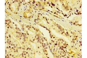 IHC image of ABIN7149752 diluted at 1:400 and staining in paraffin-embedded human prostate cancer performed on a Leica BondTM system. (Dermcidin 抗体  (AA 20-110))