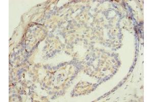 Immunohistochemistry of paraffin-embedded human breast cancer using ABIN7176453 at dilution of 1:100 (ZNF626 抗体  (AA 1-92))