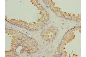 Immunohistochemistry of paraffin-embedded human prostate cancer using ABIN7145497 at dilution of 1:100 (GLB1L2 抗体  (AA 401-636))