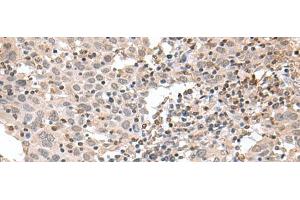 Immunohistochemistry of paraffin-embedded Human cervical cancer tissue using TDP2 Polyclonal Antibody at dilution of 1:75(x200) (TDP2 抗体)