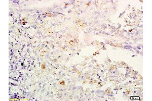 Formalin-fixed and paraffin embedded human lung carcinoma labeled with Anti-IL-32/NK4 Polyclonal Antibody, Unconjugated (ABIN748298) at 1:200 followed by conjugation to the secondary antibody and DAB staining (IL32 抗体  (AA 151-234))