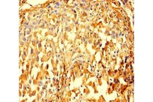 Immunohistochemistry of paraffin-embedded human lung cancer using ABIN7156292 at dilution of 1:100 (IMPDH2 抗体  (AA 5-514))