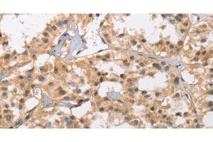 Immunohistochemistry of paraffin-embedded Human thyroid cancer tissue using Cav1.