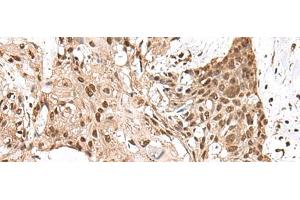 Immunohistochemistry of paraffin-embedded Human esophagus cancer tissue using MAGOHB Polyclonal Antibody at dilution of 1:70(x200) (Mago Nashi Homolog 2 抗体)