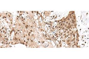 Immunohistochemistry of paraffin-embedded Human esophagus cancer tissue using MAGOHB Polyclonal Antibody at dilution of 1:70(x200)
