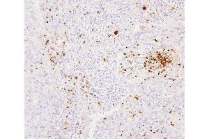 IHC analysis of CEACAM5 using anti-CEACAM5 antibody (ABIN7601435).