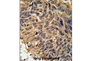 FBXL2 Antibody (C-term) (ABIN651220 and ABIN2840138) IHC analysis in formalin fixed and paraffin embedded human lung carcinoma followed by peroxidase conjugation of the secondary antibody and DAB staining. (FBXL2 抗体  (C-Term))