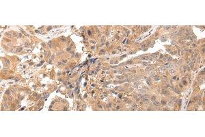 Immunohistochemistry of paraffin-embedded Human breast cancer tissue using CLDND2 Polyclonal Antibody at dilution 1:45 (CLDND2 抗体)